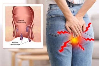 Top Herbal Capsules for Piles Relief in Pakistan – Safe & Effective Solution